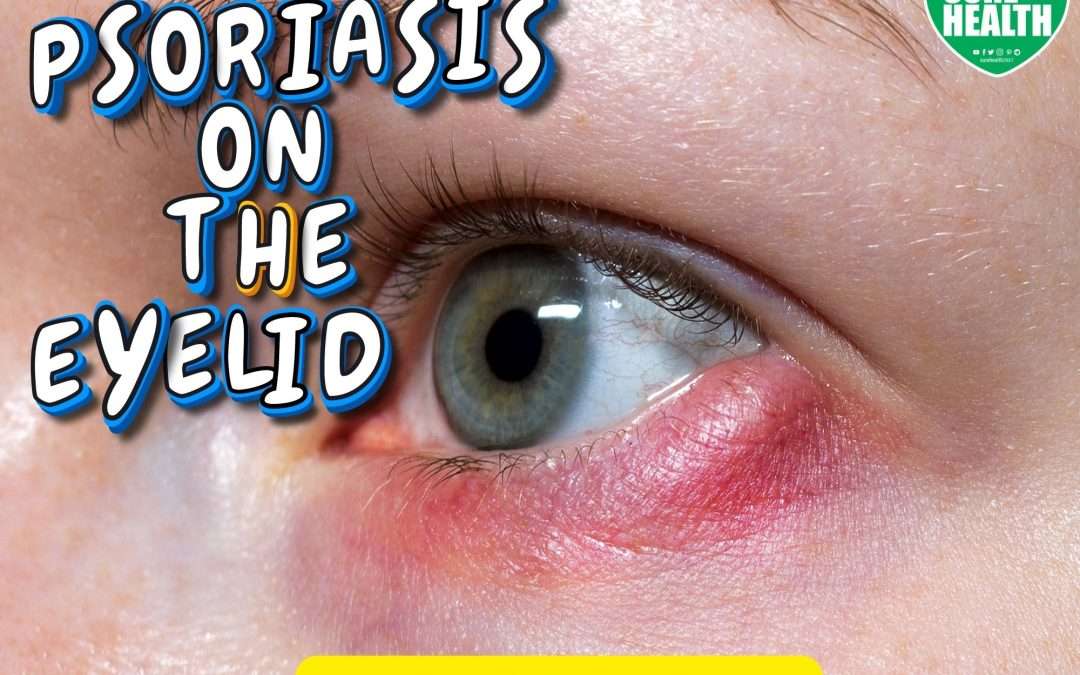 Psoriasis On The Eyelid Understanding Symptoms Causes And Effective Management Sure Health
